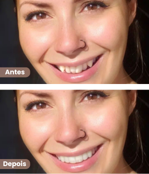 Antes e depois de alinhadores dentários invisíveis em Sorocaba na clínica Harmodont