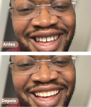 Antes e depois de alinhadores dentários invisíveis em Sorocaba na clínica Harmodont