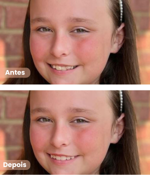 Antes e depois de alinhadores dentários invisíveis em Sorocaba na clínica Harmodont