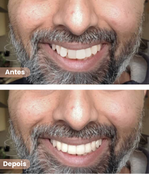Antes e depois de alinhadores dentários invisíveis em Sorocaba na clínica Harmodont