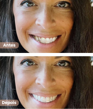 Antes e depois de alinhadores dentários invisíveis em Sorocaba na clínica Harmodont