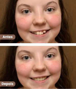 Antes e depois de alinhadores dentários invisíveis em Sorocaba na clínica Harmodont